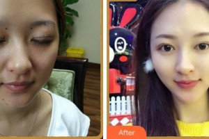 寧波鄞州區(qū)第二醫(yī)院眼科劉惠姣整形價格表附眼部綜合案例展示