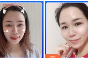 寧波鄞州區(qū)第二醫(yī)院眼科黃玉庚整形價格表附眼部綜合案例展示