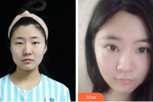 寧波市第九醫(yī)院眼科裘文嫻整形價格表附切開雙眼皮案例展示