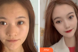 深圳瑞芙臣醫(yī)療美容門(mén)診部劉顏顏整形價(jià)格表附鼻部手術(shù)案例展示