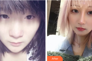 深圳麗港麗格醫(yī)療美容門(mén)診部謝俊整形價(jià)格表附隆鼻案例展示