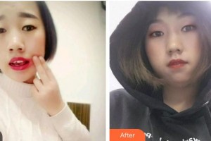 寧波牙博士口腔醫(yī)院金勇和整形價格表附根管調節(jié)案例展示