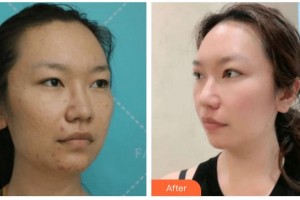 寧波市華慈醫(yī)院眼科周偉整形價(jià)格表附切開(kāi)雙眼皮案例展示