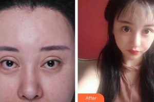 寧波市華慈醫(yī)院眼科張迎書(shū)整形價(jià)格表附眼部修復(fù)案例展示