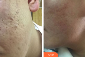 深圳麗港麗格醫(yī)療美容門(mén)診部舒暢整形價(jià)格表附微針淡化痘印案例展示