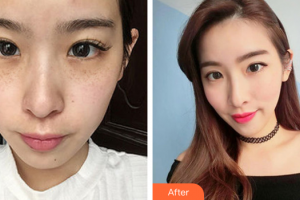 深圳麗港麗格醫(yī)療美容門(mén)診部易仁祥整形價(jià)格表附激光祛斑案例展示