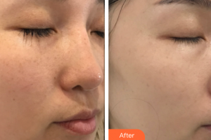 深圳韓佳醫(yī)療美容門(mén)診部王煥英整形價(jià)格表附多方面部較準(zhǔn)祛斑案例展示