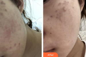 深圳春天海岸醫(yī)療美容門(mén)診部李康勇整形價(jià)格表附蜂巢激光美膚祛斑案例展示