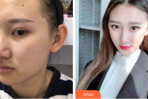 深圳韓佳醫(yī)療美容門(mén)診部周爽整形價(jià)格表附面部吸脂瘦臉案例展示