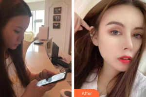 深圳幸福醫(yī)療美容門診部李丹陽整形價(jià)格表附假體豐眉弓案例展示