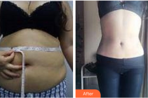 深圳博愛曙光醫(yī)院苗春來整形價(jià)格表附腰腹吸脂案例展示