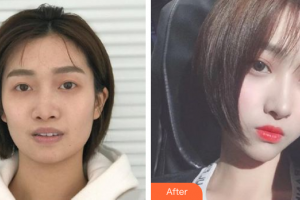 深圳博愛曙光醫(yī)院薛鐵華整形價(jià)格表附假體隆鼻案例展示