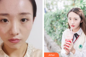 深圳民生婦科醫(yī)院整形美容中心張偉彬整形價(jià)格表附鼻部手術(shù)案例展示