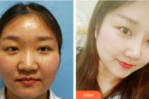 深圳博愛醫(yī)院整形美容中心許國明整形價(jià)格表附鼻部手術(shù)案例展示