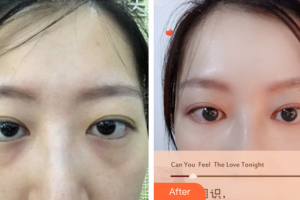 深圳瑞芙臣醫(yī)療美容門診部劉丹虹整形價(jià)格表附內(nèi)路去眼袋案例展示