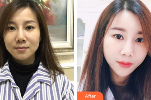 深圳瑞芙臣醫(yī)療美容門診部許金壽整形價(jià)格表附自體脂肪填充案例展示