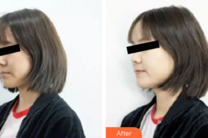 深圳鵬程醫(yī)院整形美容中心孫翠蓮整形價(jià)格表附激光美膚掃黃案例展示