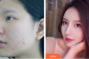 深圳鵬程醫(yī)院整形美容中心解慧慧住院醫(yī)師整形價(jià)格表附紅藍(lán)光祛痘案例展示