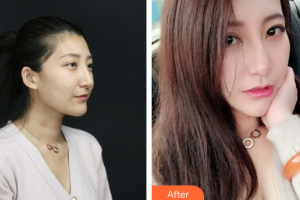 深圳鵬程醫(yī)院整形美容中心王善祥整形價(jià)格表附美白嫩膚案例展示