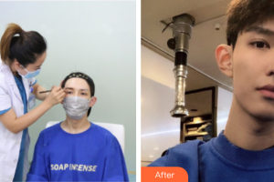 深圳鵬程醫(yī)院整形美容中心張小青整形價(jià)格表附種植眉毛案例展示