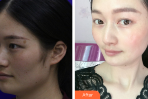 深圳百合醫(yī)療美容門診部王定芳整形價(jià)格表附祛斑祛痣案例展示