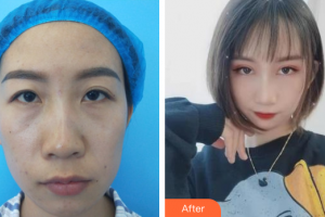 深圳西諾醫(yī)療美容門診部王美懿整形價(jià)格表附眼部綜合案例展示