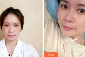 寧波藝星整形美容醫(yī)院潘炯波整形價(jià)格表附切開(kāi)雙眼皮案例展示