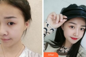 溫州雅美姬整形美容醫(yī)院李敏錫整形價(jià)格表附眼部綜合案例展示