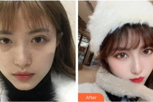 溫州藝星醫(yī)學美容醫(yī)院周聰鐸整形價格表附熱瑪吉案例展示