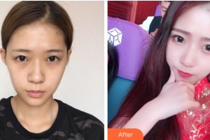 溫州藝星醫(yī)學美容醫(yī)院賀忠波整形價格表附眼部綜合案例展示