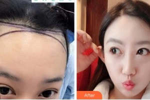 溫州伊美爾加禾植發(fā)診所呂輝整形價格表附種植發(fā)際線案例展示