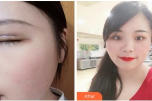 溫州星范醫(yī)學美容門診部葉信海整形價格表附切開雙眼皮案例展示