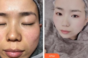 溫州星范醫(yī)學美容門診部徐慧整形價格表附激光祛斑案例展示