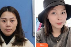 溫州解放軍118醫(yī)院整形科羅興華整形價格表附眼部整形案例展示