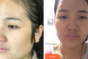 溫州解放軍118醫(yī)院整形科程靜文整形價格表附激光祛斑案例展示