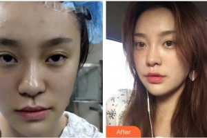 溫州雅美姬整形美容醫(yī)院蔡亮整形價格表附埋線提升案例展示