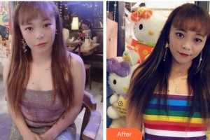 溫州解放軍118醫(yī)院整形科鄒先彪整形價格表附埋線提升案例展示