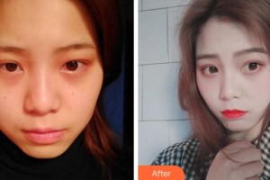 溫州雅美姬整形美容醫(yī)院丁愛華整形價格表附激光美膚祛斑案例展示