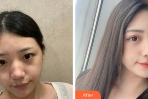 溫州解放軍118醫(yī)院整形科李恒進(jìn)整形價格表附激光祛斑案例展示