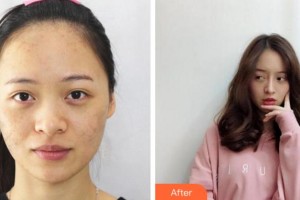 溫州解放軍118醫(yī)院整形科呂瑾整形價格表附激光祛斑案例展示