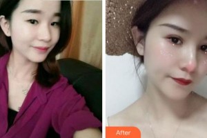 溫州藝星醫(yī)學(xué)美容醫(yī)院許炎龍整形價格表附眼部綜合案例展示