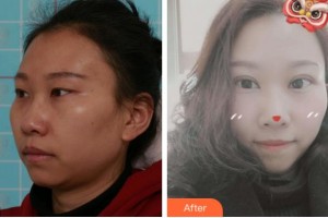 溫州芘麗芙美容醫(yī)院梁富榮整形價格表附切開雙眼皮案例展示