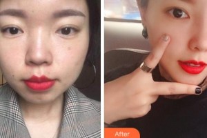 溫州醫(yī)學(xué)院附屬第一醫(yī)院整形外科李力群整形價格表附耳軟骨復(fù)合隆鼻案例展示