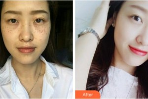 溫州同德醫(yī)院整形美容中心李冬梅整形價格表附祛斑案例展示