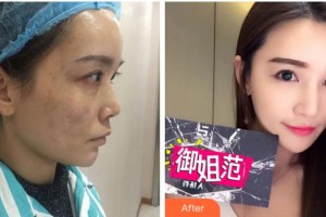 溫州和平整形醫(yī)院李張玲整形價格表附激光祛斑案例展示