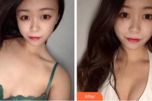 溫州解放軍118醫(yī)院整形科安伯忠整形價格表附自體脂肪隆胸案例展示