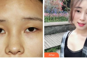 溫州藝美整形美容醫(yī)院季豪整形價格表附埋線雙眼皮案例展示