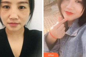 溫州韓美整形美容醫(yī)院紀強整形價格表附眼部綜合案例展示