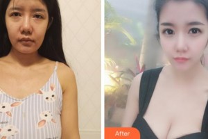 溫州韓美整形美容醫(yī)院邰守權整形價格表附隆胸案例展示