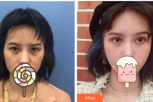 溫州東華醫(yī)院醫(yī)療美容科張群整形價格表附切開雙眼皮案例展示